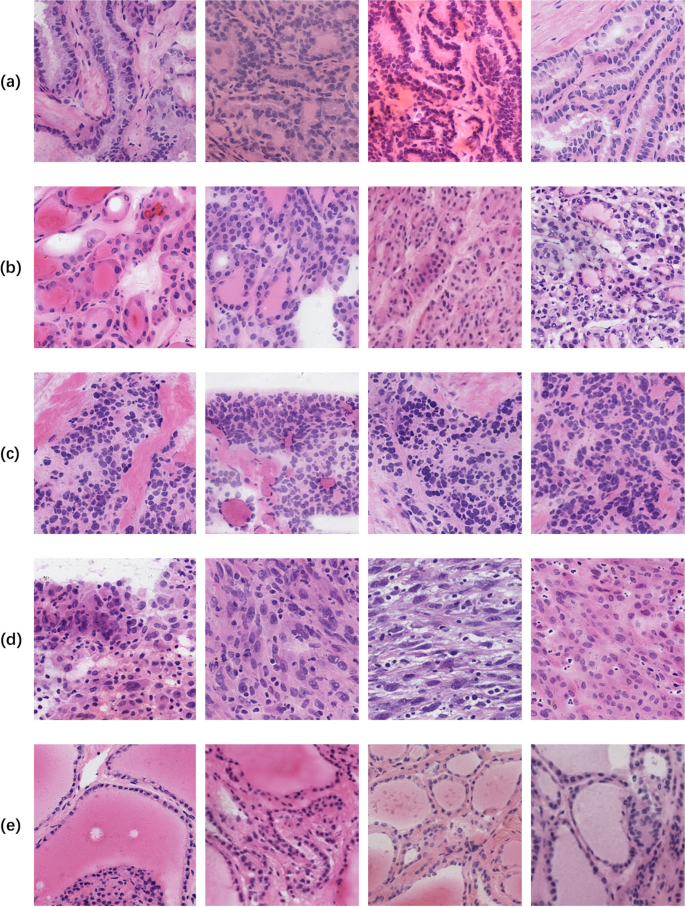 current research on thyroid cancer figure 4