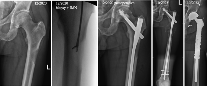 Palliative care of proximal femur metastatic disease and 