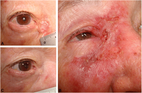 Imiquimod cream efficacy in the treatment of periocular nodular basal cell  carcinoma: a non-randomized trial | BMC Ophthalmology | Full Text