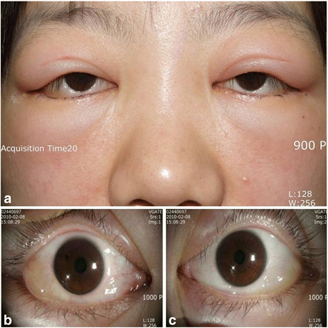 Eye Conditions Associated With Lupus