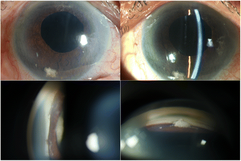 Pseudophakic angle-closure from a Soemmering ring | BMC Ophthalmology |  Full Text