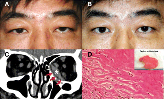 Delayed Onset Porous Polyethylene Implant Related Inflammation