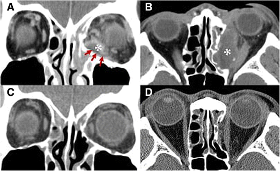 Delayed Onset Porous Polyethylene Implant Related Inflammation