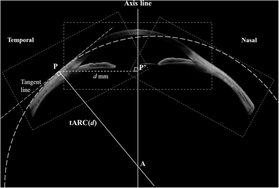 Estimation of axial curvature of anterior sclera: correlation between axial  length and anterior scleral curvature as affected by angle kappa | BMC  Ophthalmology | Full Text