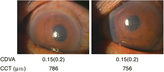 inflammation 6 weeks after cataract surgery)