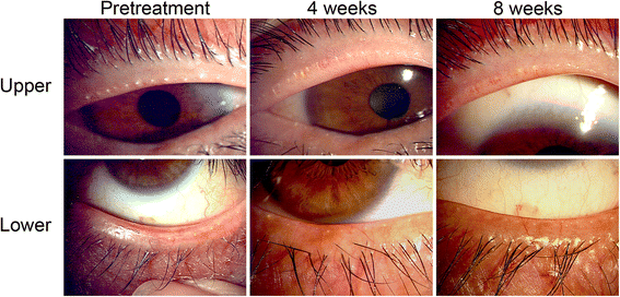 Clinical safety and efficacy of vitamin D3 analog ointment for treatment of  obstructive meibomian gland dysfunction | BMC Ophthalmology | Full Text