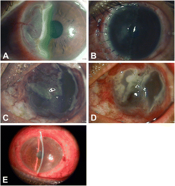 Rapid Deterioration Of Mooren S Ulcers After Conjunctival Flap A Review Of 2 Cases Bmc Ophthalmology Full Text