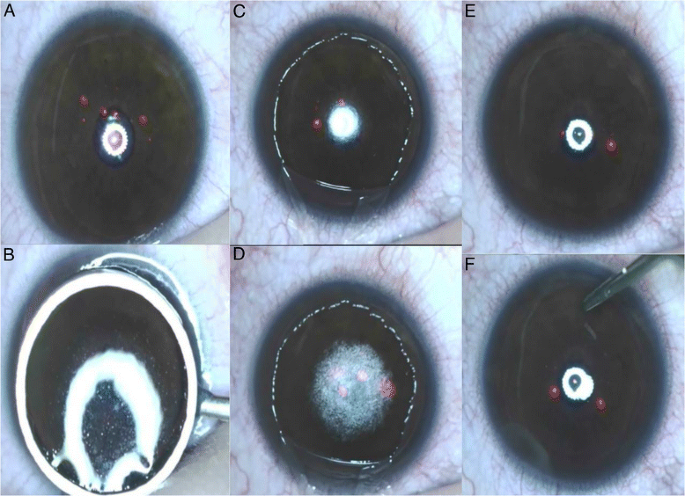 A pilot study: LASEK with the Triple-A profile of a MEL 90 for mild and  moderate myopia | BMC Ophthalmology | Full Text