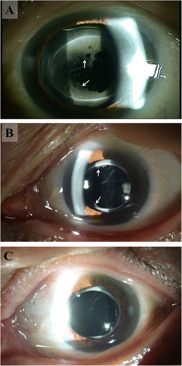 Reversible opacification of hydrophobic acrylic intraocular lens- two cases  report | BMC Ophthalmology | Full Text