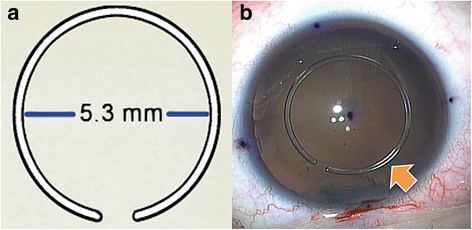Clinical Results Of The Open Ring Pmma Guider Assisted Capsulorrhexis In Cataract Surgery Bmc Ophthalmology Full Text