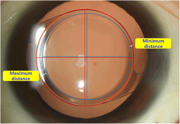 Clinical Results Of The Open Ring Pmma Guider Assisted Capsulorrhexis In Cataract Surgery Bmc Ophthalmology Full Text