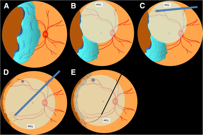 Management of Giant Retinal Tear with microincision vitrectomy and metallic  retinal tacks fixation-a case report | BMC Ophthalmology | Full Text