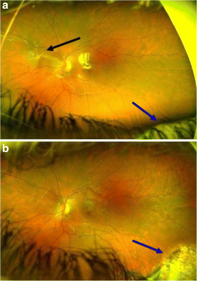 Open globe and penetrating eyelid injuries from fish hooks, BMC  Ophthalmology