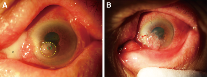 Individualized penetrating keratoplasty using edge-trimmed  glycerol-preserved donor corneas for perforated corneal ulcers | BMC  Ophthalmology | Full Text