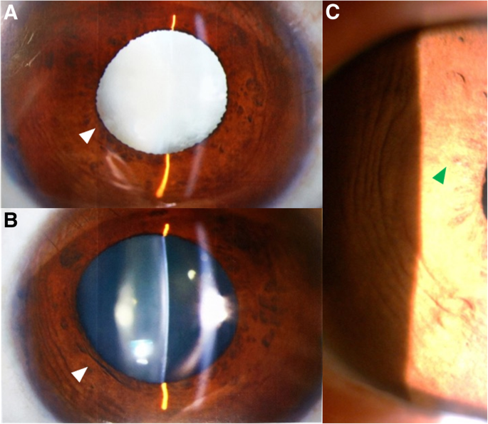 How many challenges we may encounter in anterior megalophthalmos with white  cataract: a case report | BMC Ophthalmology | Full Text