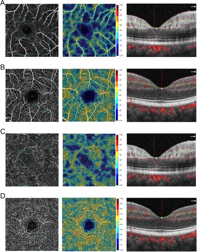 Optical Coherence Tomography Angiography Characteristics Of Acute Retinal Arterial Occlusion Bmc Ophthalmology Full Text