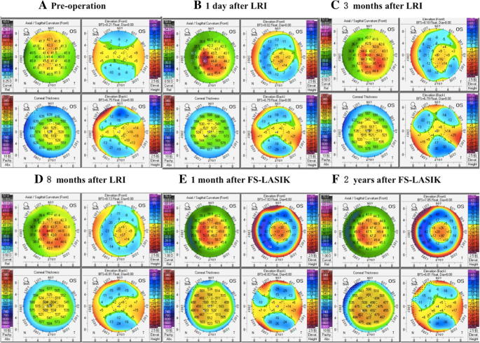 Two-year outcome of an eye that underwent hyperopic LASIK following  inadvertent myopic SMILE lenticule in situ implantation | BMC Ophthalmology  | Full Text