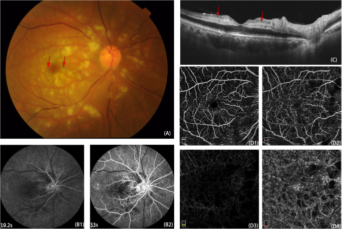 Purtscher-like retinopathy presented a honeycomb-like pattern in optical  coherence topography angiography | BMC Ophthalmology | Full Text