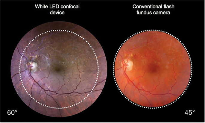 A comparison between a white LED confocal imaging system and a conventional  flash fundus camera using chromaticity analysis | BMC Ophthalmology | Full  Text