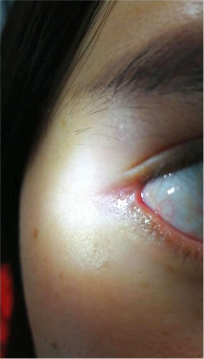 Case report of conjunctival sac fistula after cosmetic lateral canthoplasty  | BMC Ophthalmology | Full Text
