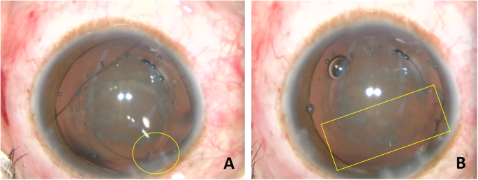 Femtosecond laser assisted cataract surgery in a cataract patient with a “0  vaulted” ICL: a case report | BMC Ophthalmology | Full Text