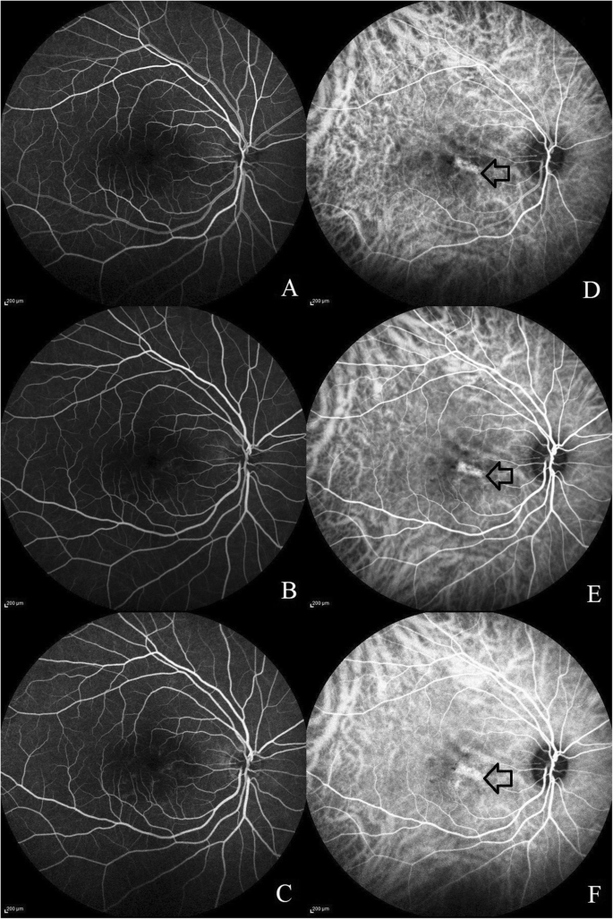 Minoxidil induced central serous Chorioretinopathy treated with oral  Eplerenone – a case report | BMC Ophthalmology | Full Text