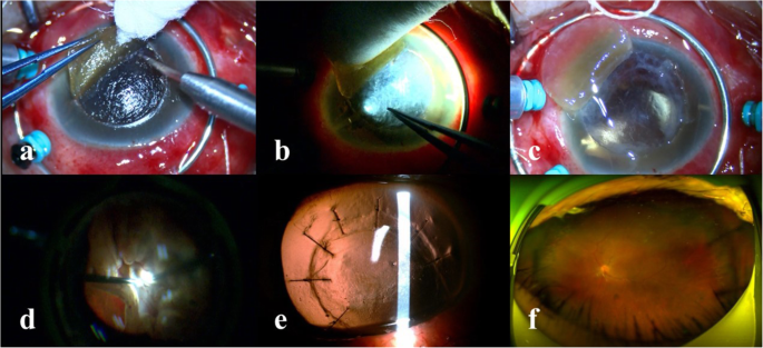 Modified Deep Anterior Lamellar Dissection For Corneal Opacity During Vitrectomy Case Reports Bmc Ophthalmology Full Text