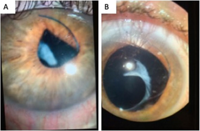 als resultaat rollen liberaal Late intraocular Lens dislocation following scleral depression: a case  report | BMC Ophthalmology | Full Text