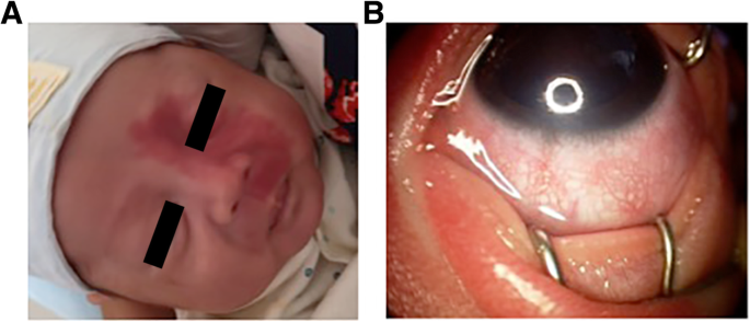 Progressive retinal vessel malformation in a premature infant with Sturge- Weber syndrome: a case report and a literature review of ocular  manifestations in Sturge-Weber syndrome | BMC Ophthalmology | Full Text