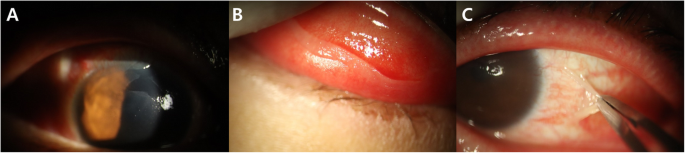 Pseudomembranous Conjunctivitis With Hand Foot And Mouth Disease In A Pregnant Woman A Case Report Bmc Ophthalmology Full Text