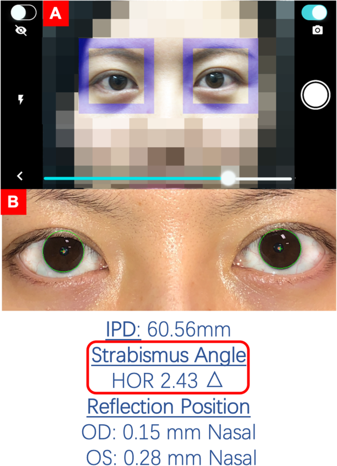 A Smartphone Ocular Alignment Measurement App In School Screening For Strabismus Bmc Ophthalmology Full Text