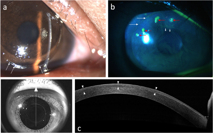 Traumatic displacement of laser in situ keratomileusis flaps: an integrated  clinical case presentation | BMC Ophthalmology | Full Text
