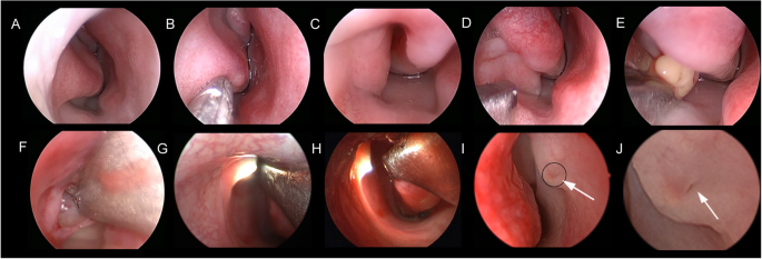 Dacryoendoscopy-assisted incision of Hasner's valve under nasoendoscopy for  membranous congenital nasolacrimal duct obstruction after probing failure:  a retrospective study | BMC Ophthalmology | Full Text