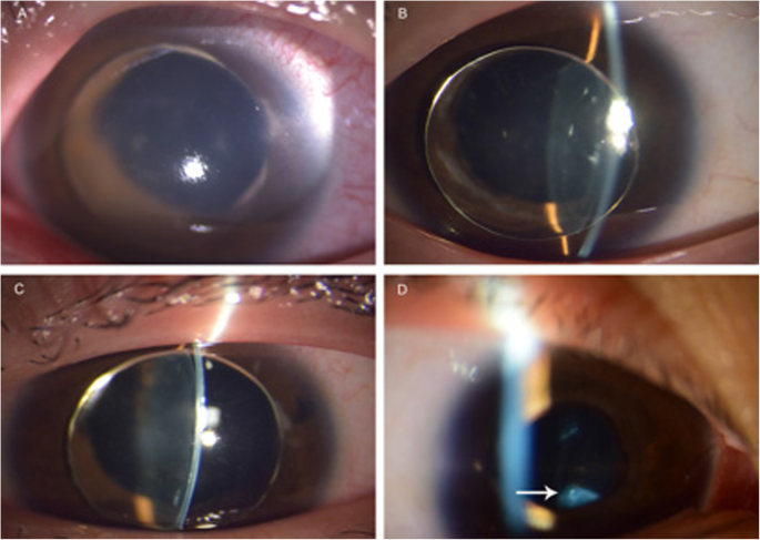 Recurrent dislocation of binocular crystal lenses in a patient with  cystathionine beta-synthase deficiency | BMC Ophthalmology | Full Text
