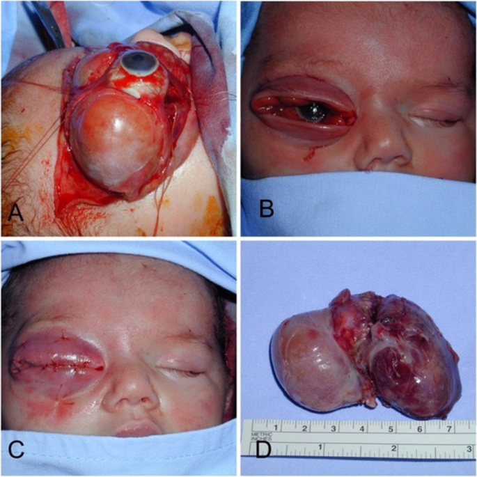 Teratoma tumor