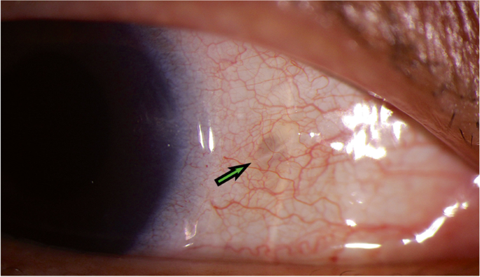 A novel surgical approach for fixation of a posterior chamber intraocular  lens of Rayner 620 H with Gore-Tex suture | BMC Ophthalmology | Full Text