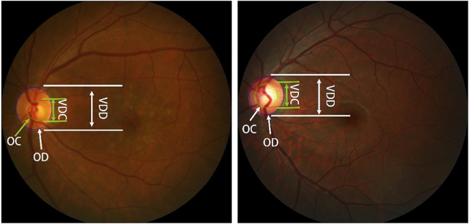 Research on segmentation model of optic disc and optic cup in 