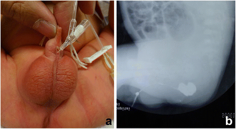 Imperforate anus with rectopenile fistula: a case report and systematic  review of the literature | BMC Pediatrics | Full Text