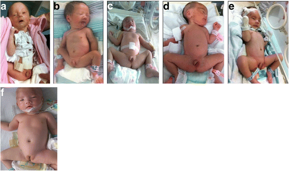 Prader–Willi syndrome in neonates: twenty cases and review of the  literature in Southern China | BMC Pediatrics | Full Text