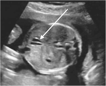 gallbladder ultrasound transverse