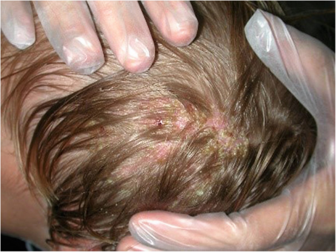 A case report of tinea capitis in infant in first year of life | BMC  Pediatrics | Full Text