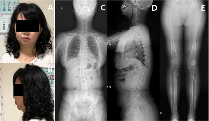 A family of Melnick-Needles syndrome: a case report | BMC Pediatrics | Full  Text