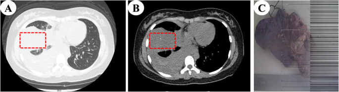 Primary pulmonary Ewing's sarcoma: rare cause of massive hemothorax in a  young girl-case report | BMC Pediatrics | Full Text