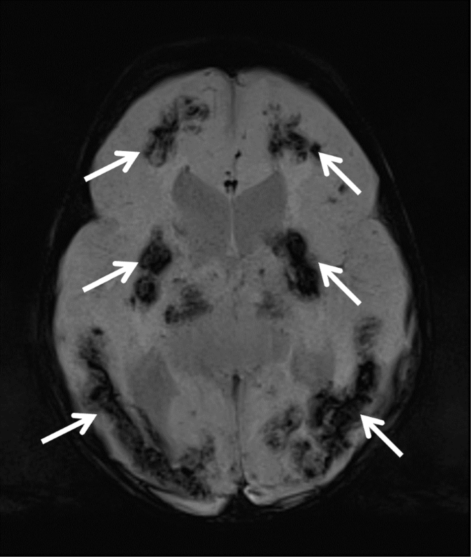 Coats plus syndrome: a rare cause of severe gastrointestinal tract bleeding  in children – a case report | BMC Pediatrics | Full Text