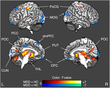 Gray Matter Density Increases During >> What Is The Impact Of Child Abuse On Gray Matter Abnormalities In Gray Matter Density Increases During >> What Is The Impact Of Child Abuse On Gray Matter Abnormalities In