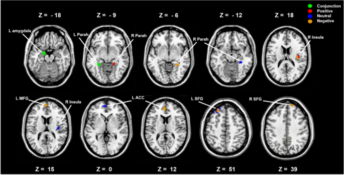 anxiety disorder brain