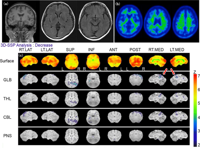 Late-onset attention-deficit/hyperactivity disorder as a differential  diagnosis of dementia: a case report | BMC Psychiatry | Full Text