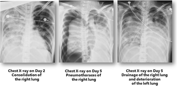 Successful rescue combination of extracorporeal membrane oxygenation,  high-frequency oscillatory ventilation and prone positioning for the  management of severe methicillin-resistant Staphylococcus aureus pneumonia  complicated by pneumothorax: a case ...