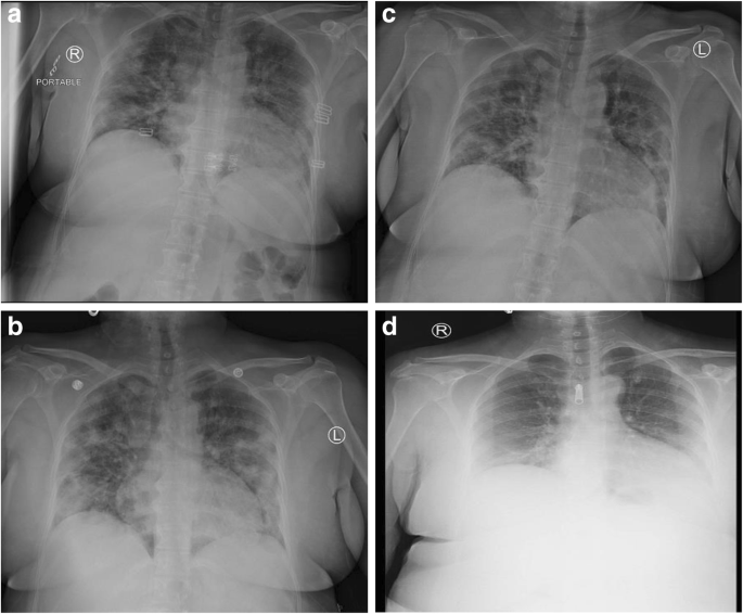 chest x ray double pneumonia