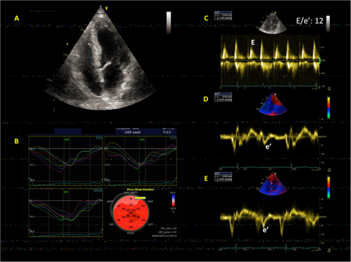 Evaluation of Subclinical LV Systolic Dysfunction by GLS Using 2D-STE